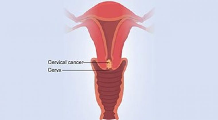 Cervical Cancer – its causes and prevention