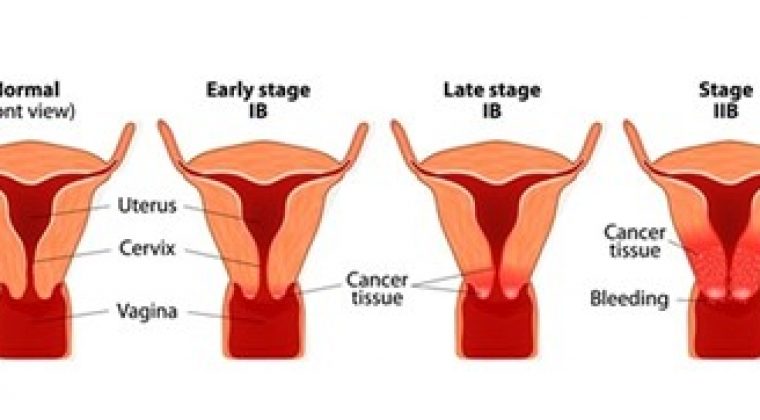 Cervical cancer, its types and staging